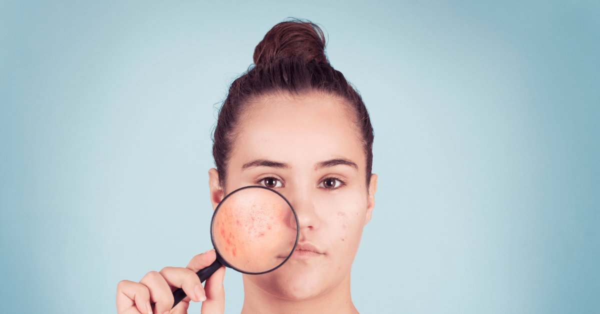 Understanding Acne: Causes, Dos, and Don’ts - Anahiherbs